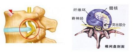 我院首例采用一次性纤维环缝合器修复纤维环治疗腰椎