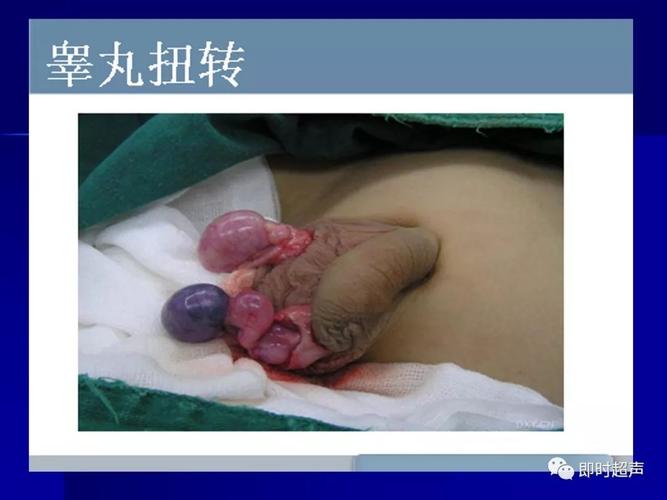 阴囊及其内容物的超声诊断