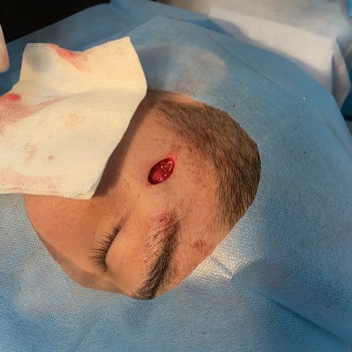 面部肿物切除术