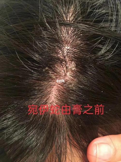 头皮癣,头皮痒而且很多头皮屑,蛇由膏擦了几天头皮不痒,了头皮屑也有