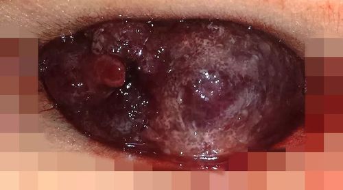 肿物,黏膜皱壁呈放射状;而完全性直肠粘膜脱垂,脱出的肿物较大较长