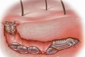 疥疮怎么治疗 治疗疥疮最快的方法