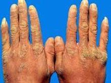 角化:疣状肢端角化症又称hopf玻该症为局部皮肤角化和颗粒团形成过度