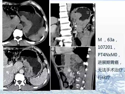 ct检查及诊断攻略胃癌结直肠癌