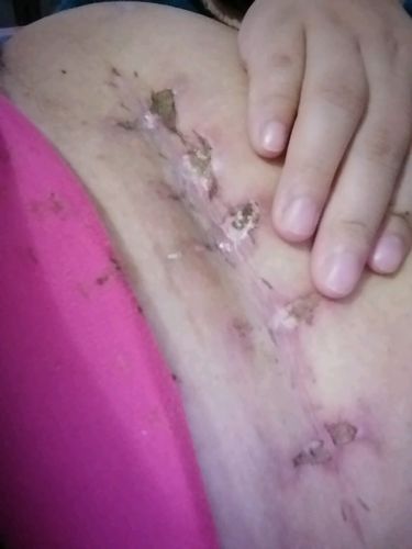 剖腹产伤口愈合太慢了