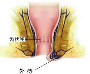 静脉曲张性外痔