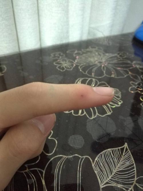 手指被中性笔扎了,里面留有黑墨水,怎么办?