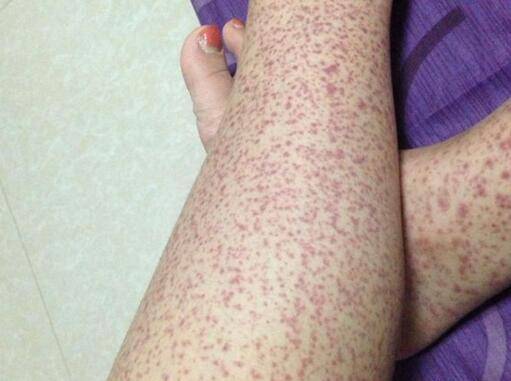 原创过敏性紫癜的病因是什么?该病是否会传染?