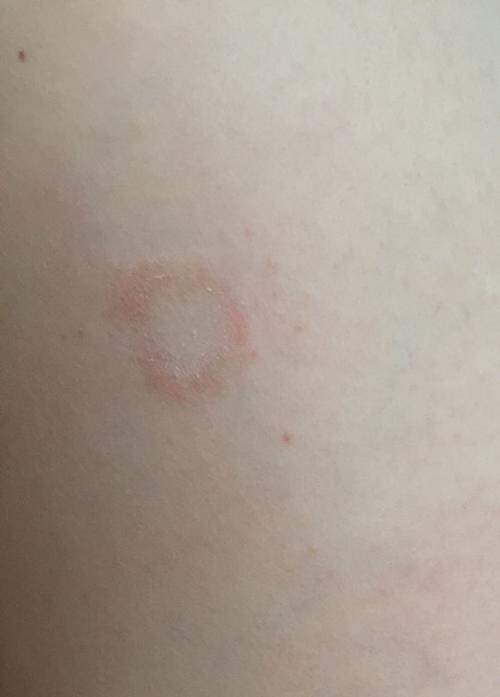 身上长的好多这种圆圈癣,请问是怎么回事