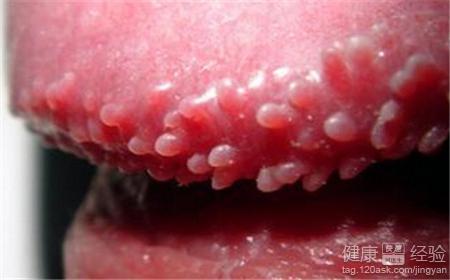 哪些男性可能更易感染尖锐湿疣疾病有哪些缘由形成男性尖锐湿疣