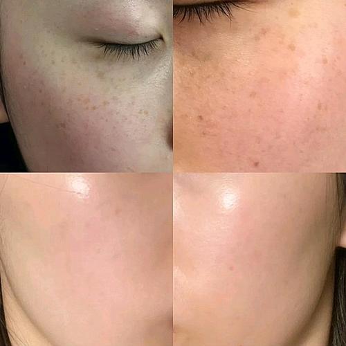 皮秒祛斑会结痂吗