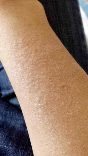 小手臂出现鸡皮疙瘩一样的东西,很痒,抹一般的皮肤药膏,附图,?