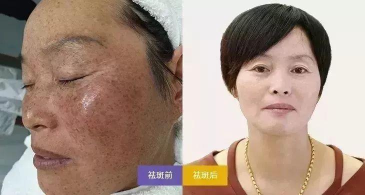 为结婚怒瘦30斤准老公却吓跑了减肥减出一脸斑宁波小娘崩溃