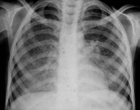 【图】间质性肺炎与肺癌一样吗? 告诉你它们的区别与三大治疗法