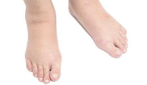 心源性水肿的发病机制 心源性水肿的特点