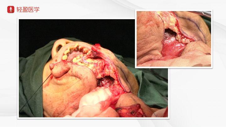 转移可能性大 【入院诊断】 扁桃体癌(右) 慢性咽喉炎 【手术方式】