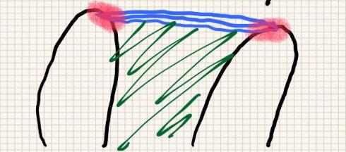 《腰痛常见病——棘上韧带炎》