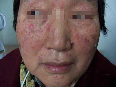 皮肤结核怎么治疗