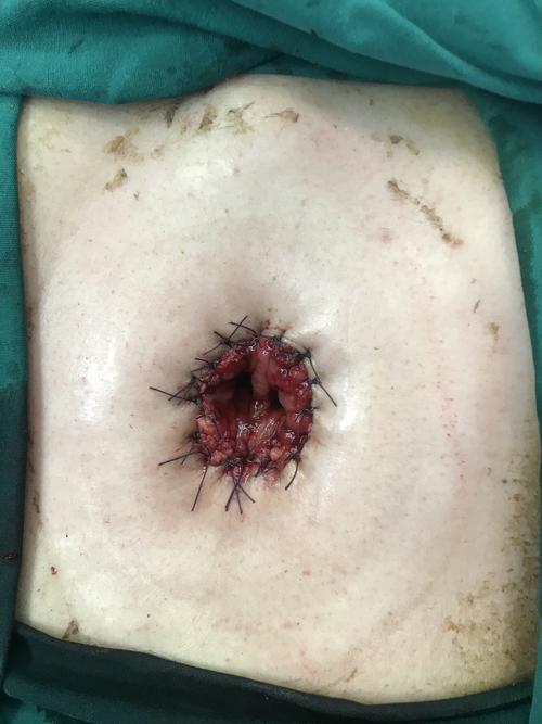 结肠造口狭窄的手术处理