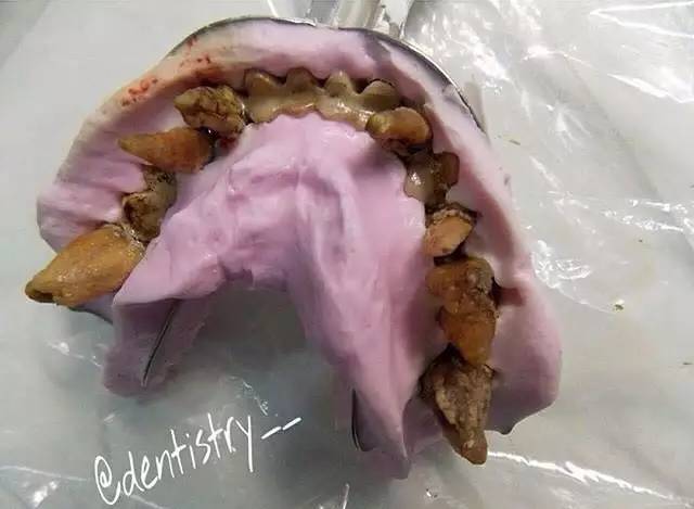 切记,不要给松动的牙齿取模型!