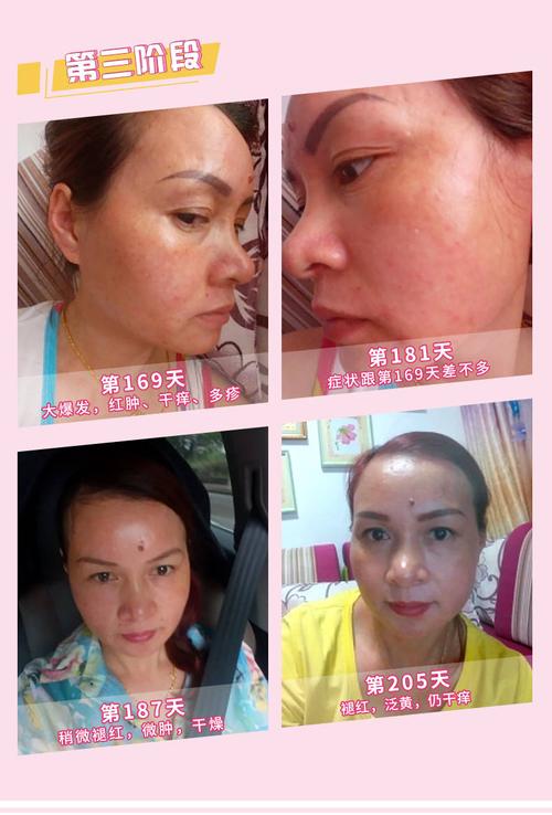 案例分享|激素脸,铅汞中毒(僵尸脸)