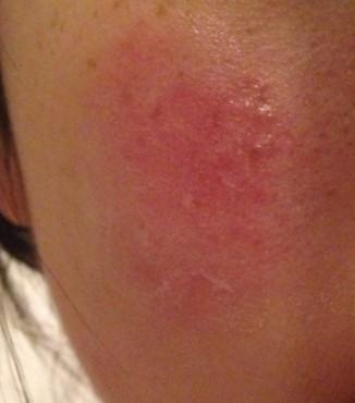 整张脸就那块地方会红 貌似上面还有痘印没消的 而且红的时候还很烫 t