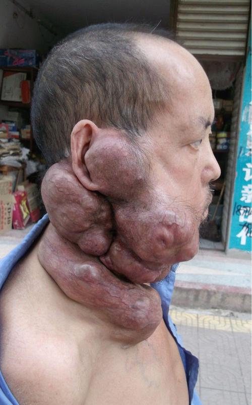 成人面部血管瘤的危害及疗法