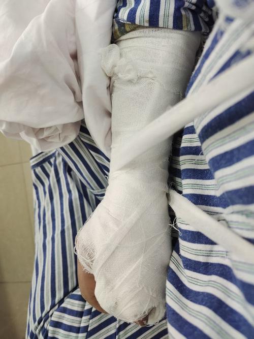 老哥们工伤骨折住院了能有什么赔偿或者补贴吗