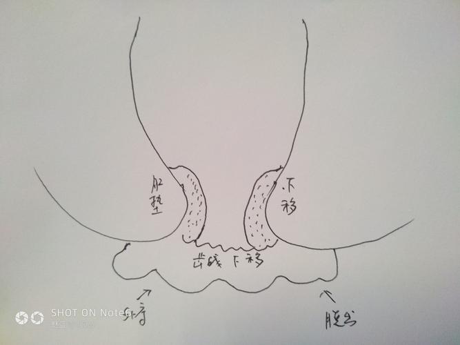 环状脱出混合痔三联法 操作过程 1,选择3,7,11点位呈柱状结扎松弛黏膜