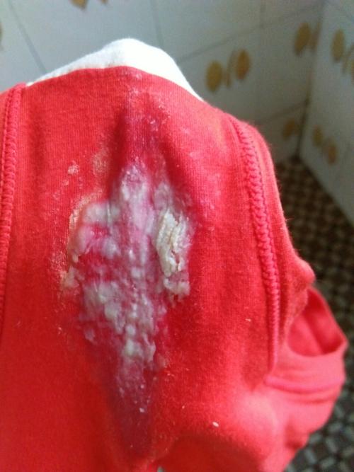 最近老是吃辣椒,这两天阴道痒,还出下面这些东西,看看这是怎么了?