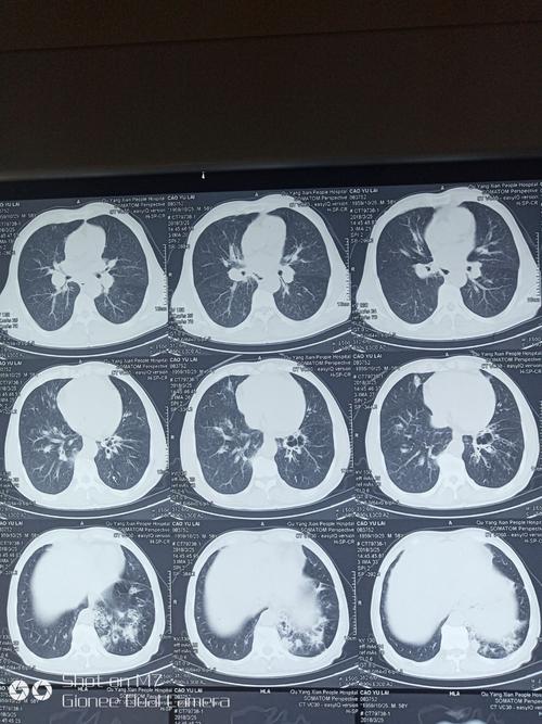 患者男性,60岁,支气管扩张合并大咯血,经给予垂体后叶素及止血药物