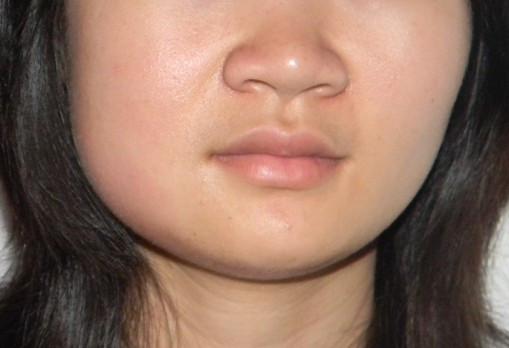 以尽快让症状消退,同时它恿餍行腮腺炎 > 流行性腮腺炎肿大特点是