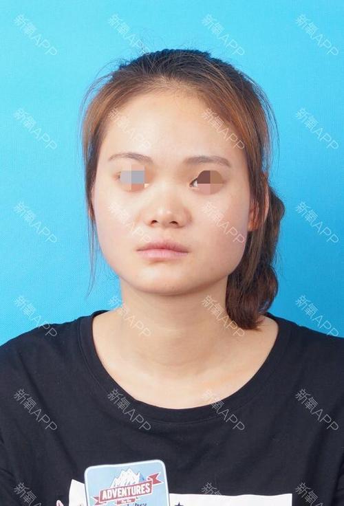 左边比右大一些,而且还有_圈子-新氧美容整形