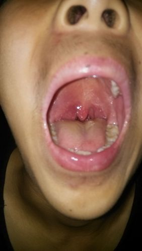 小舌头掉下来了