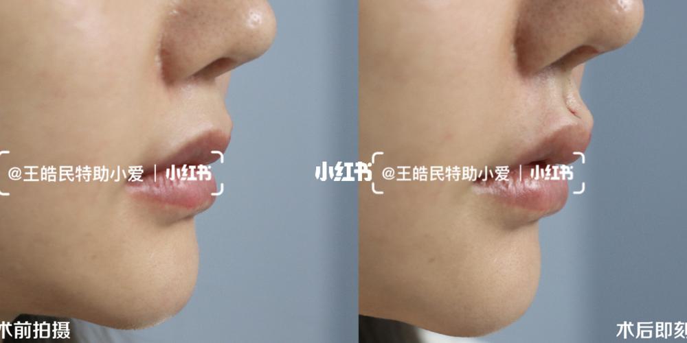 你们好奇这个哇人中窝加深_医美_你尝试过医美吗?_美妆_医美整形