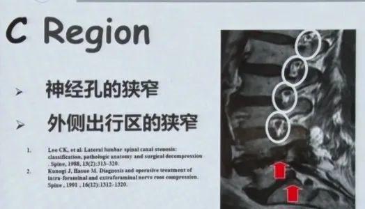 深度讲解腰椎管狭窄症的解剖及对临床治疗的意义