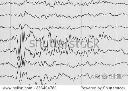 abnormal eeg brain wave on electroencephalogram eeg wave back
