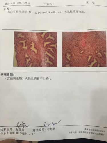 但我看病理检查说是炎性宫颈息肉不全鳞化.这个什么意思啊?