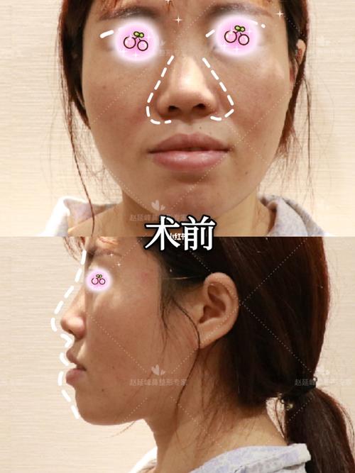 嘴凸,鼻基底凹陷很显老,这个客户就是,明明24岁的年龄