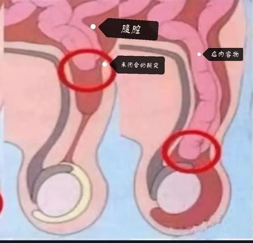 疝气|睾丸|脐疝