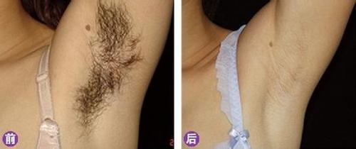 女生腋毛重哪种脱毛方法好?