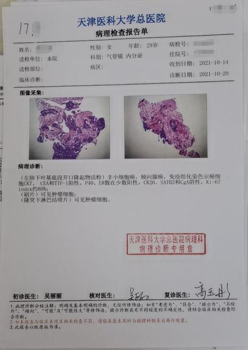 刘懿博士说肺癌(二八一六)会诊病理回来,29岁女士确诊
