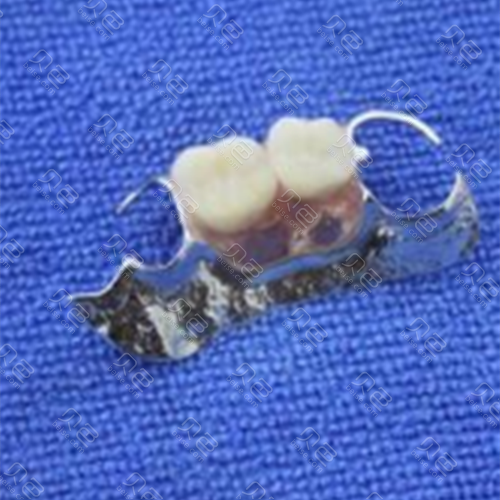 医院建议种植牙,但是一颗很贵,如果拔牙后不处理