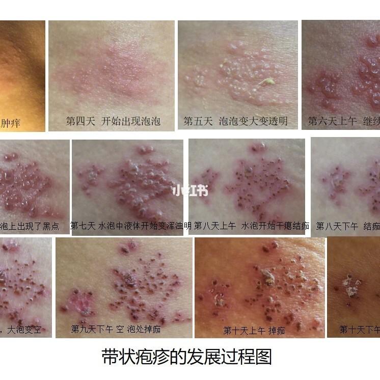 带状疱疹的发展过程_免疫力_痛经_疼痛感_母乳_隔离_母乳喂养_母婴