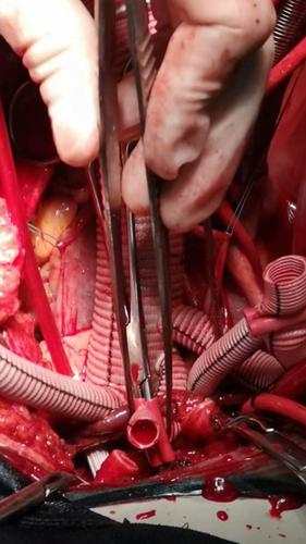 术中人工血管行升主及全弓置换