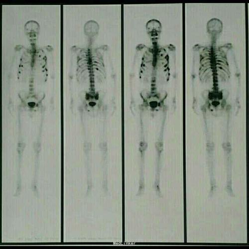 多发骨转移一例