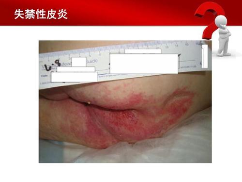 失禁性皮炎