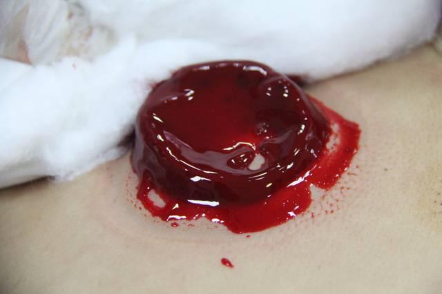 最新整理!排瘀疗法的详细操作注意点(一)