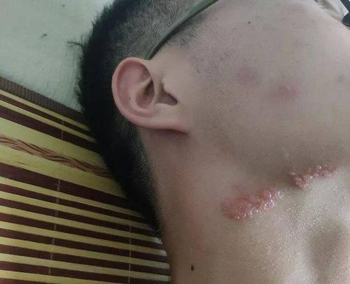 得了带状疱疹,请警惕艾滋病!