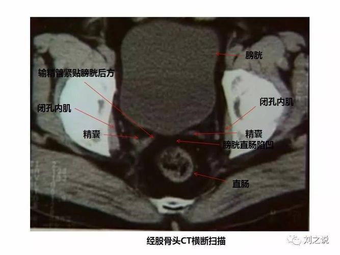 收藏必备:男性盆腔断层解剖